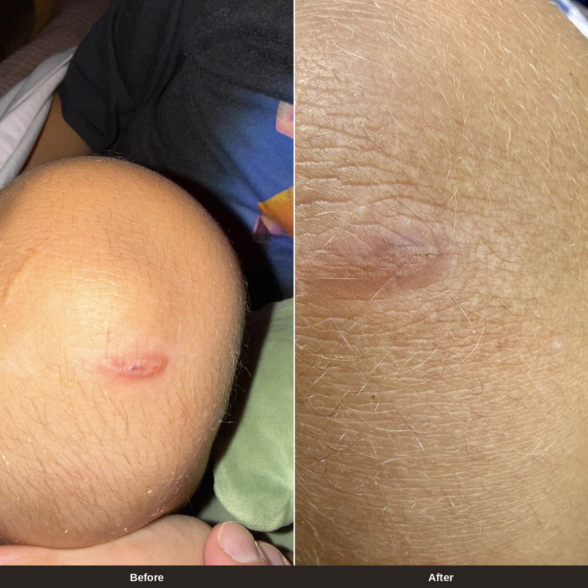 Julianna, verified buyer, Recovery Balm before and after on a lifted red scar